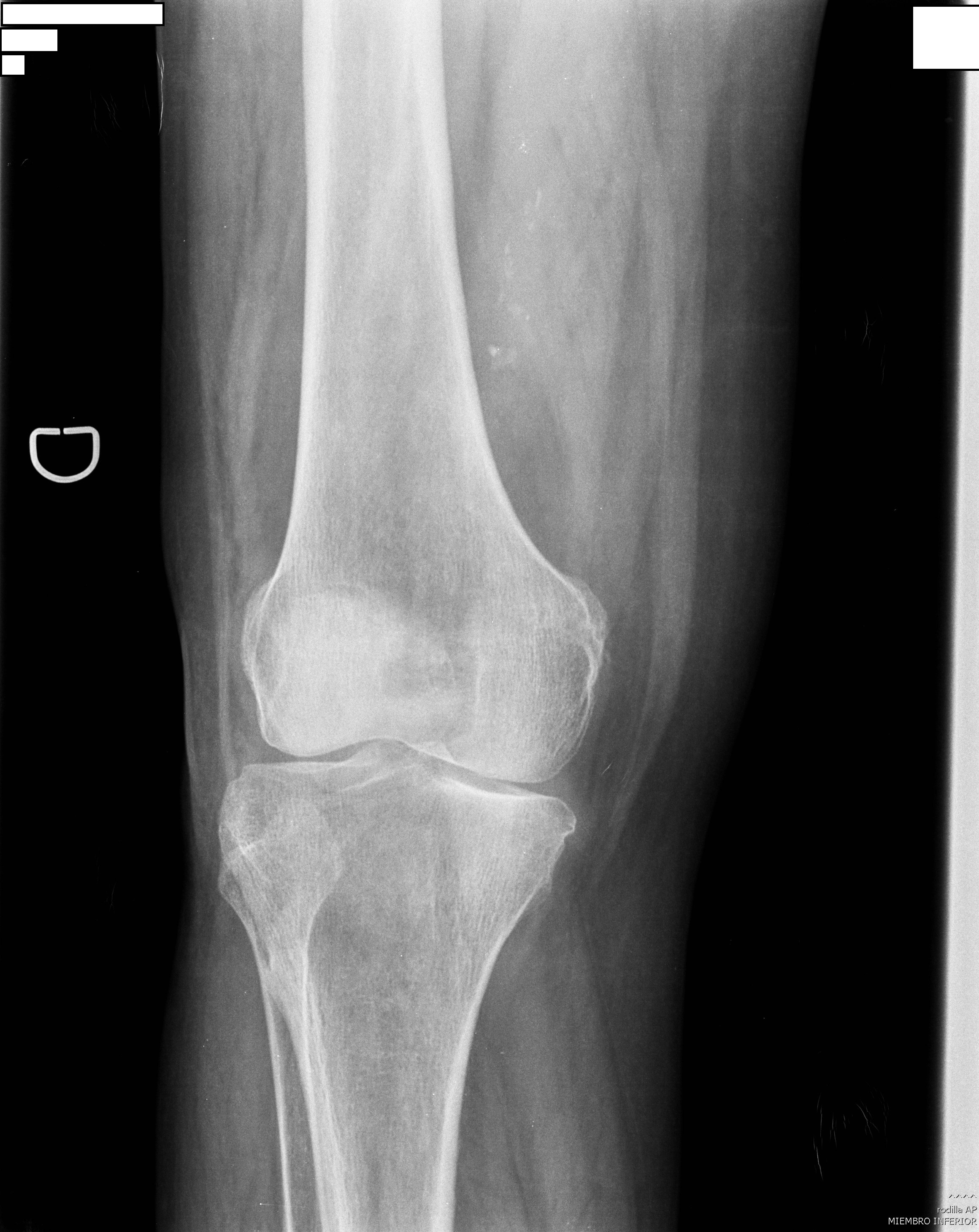Posicionamiento AP Rodilla